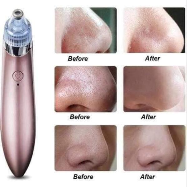 جهاز شفط الدهون